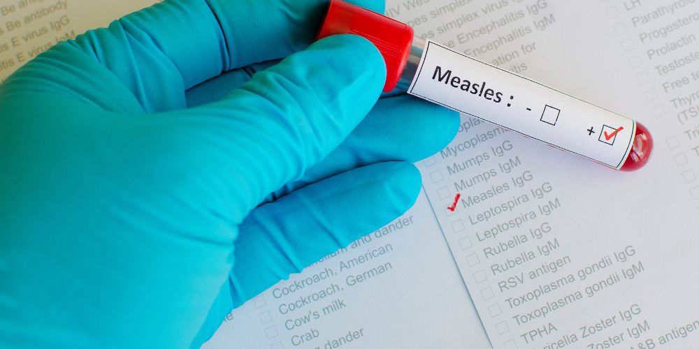 Measles cases are on the rise in Texas.